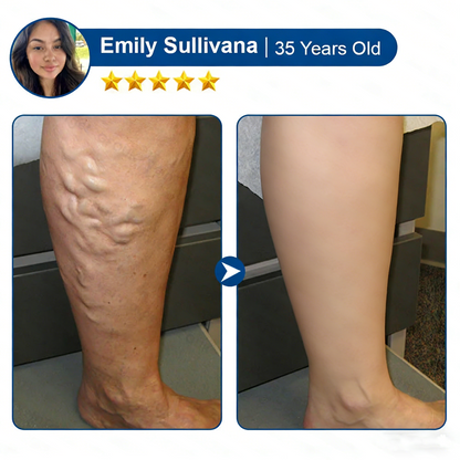 ⚡QIAWI® Vein ContourMicroneedle Patch with AdvancedDiosmin & Hesperidin Delivery 🌿 7-Day Visible Results for VaricoseVeins